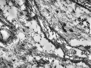 M,10y. | leiomyosarcoma M,10y. | leiomyosarcoma